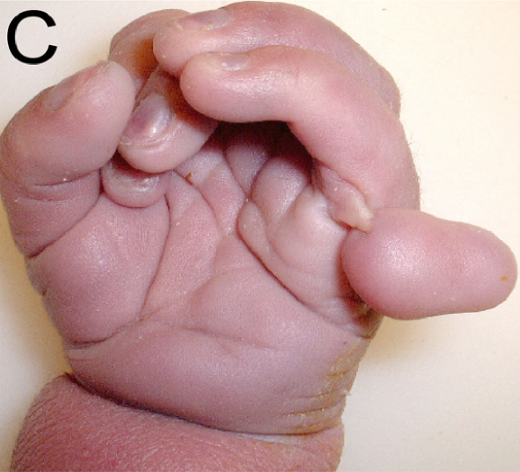 Hand with Patau Syndrome