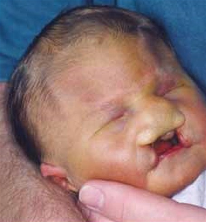 Infant With Patau Syndrome