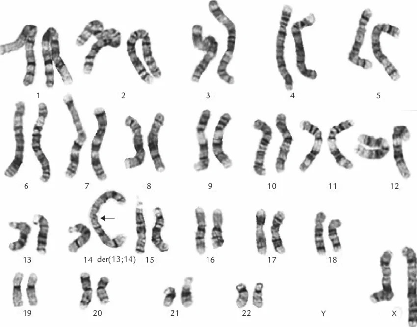Translocation Trisomy 13 Inheritance