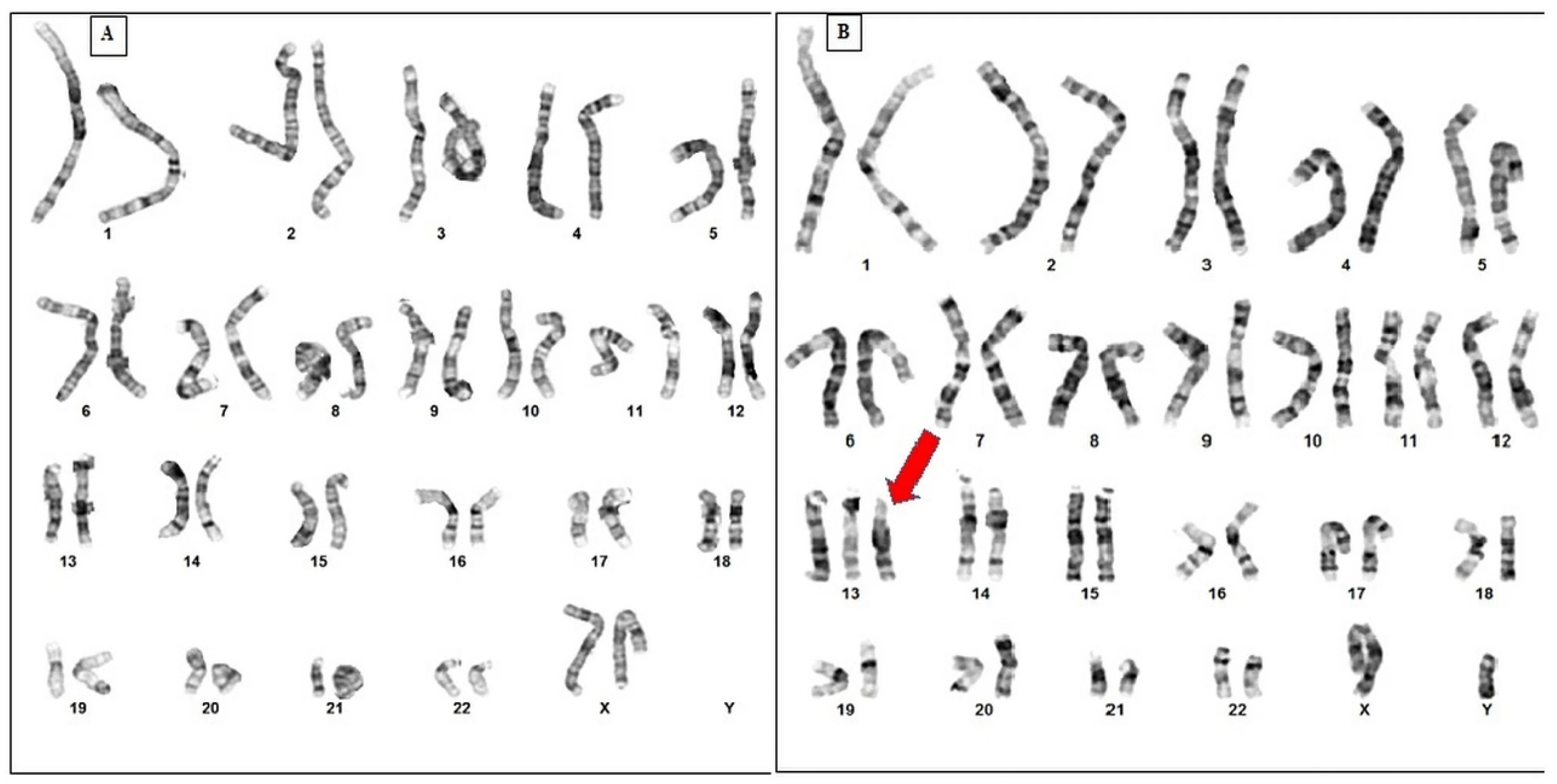 Trisomy 13 Karyotype